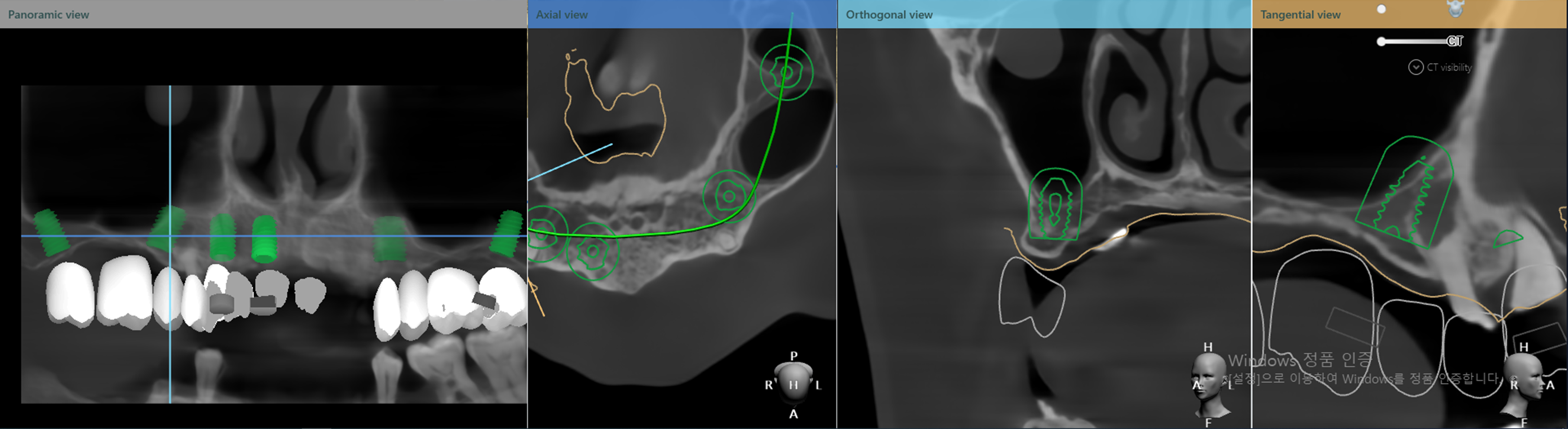 implant studio를 이용한 가이드 디자인