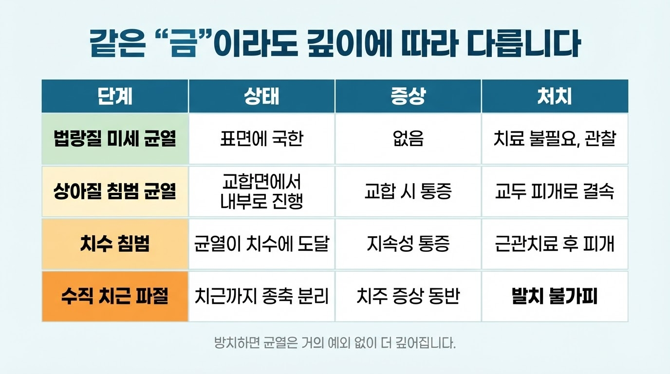 치아 균열 — 진단이 어려운 이유와 깊이별 치료
